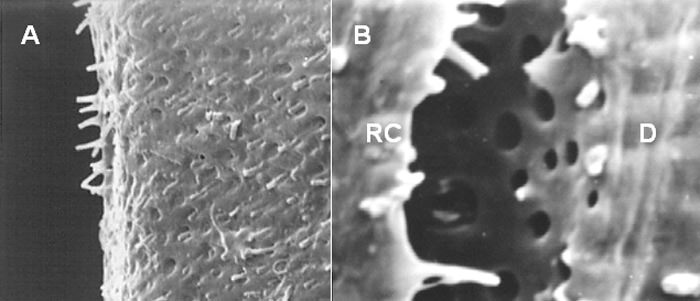 Imagen 4 Fractura Adhesiva
