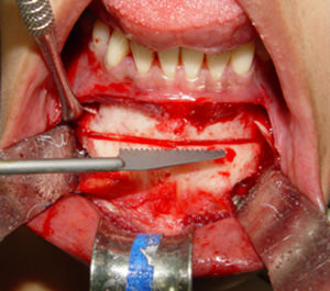 Fig. 2 Aspecto transoperatorio de la osteotomía.