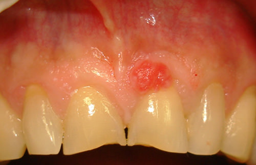 Fig. 1 Granuloma Piógeno