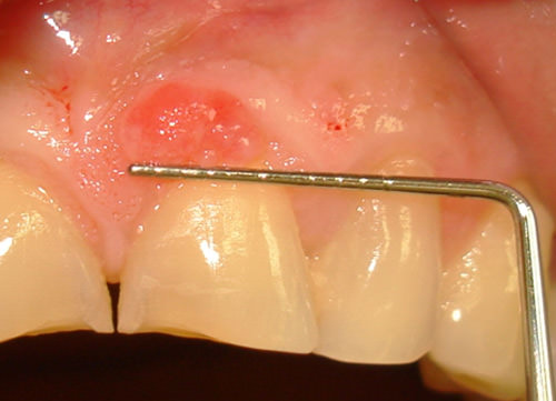 Fig. 2 Granuloma Piógeno. Lesión de 5mm aproximadamente