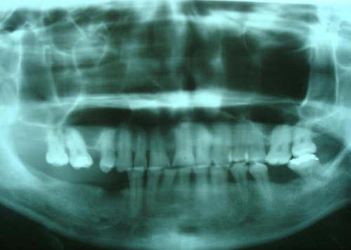 Fig. 3 Radiográficamente no se evidencia alteraciones en el periodonto de inserción