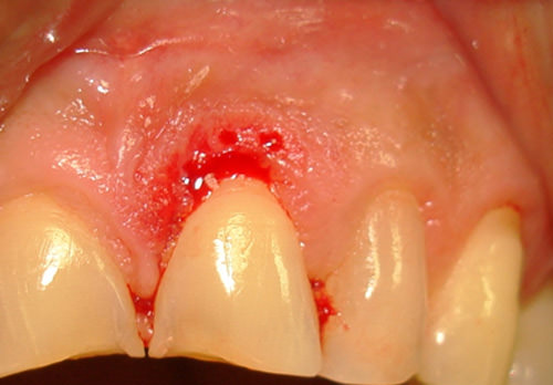 Fig. 4 Extirpación quirúrgica de la lesión