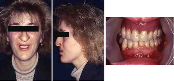 Fig. 11 (a,b,c) Imágenes finales luego de tres meses de la intervención quirúrgica ortognática. Fotografía extraoral, frontal (a) y perfil (b); vista intraoral (c) con restauraciones protésicas.