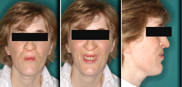 Fig.12 (a,b,c) Imágenes al cabo de 5 años de haber sido intervenida. Fotografías frontales (a y b) y perfil (c).