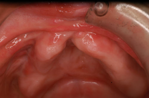 Fig. 3 Examen clínico Intraoral. Obsérvese el paladar fisurado