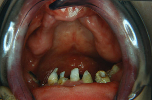 Fig. 4 Examen clínico Intraoral. Obsérvese restos radiculares en la arcada inferior