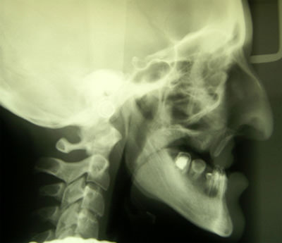 Fig. 6 Cefálica Lateral: se evidencia la gran discrepancia sagital