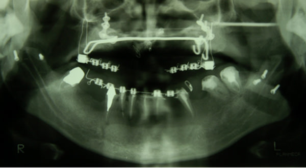 Fig 7 Radiografía panorámica donde se evidencia la fijación con los tornillos