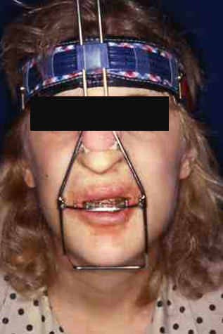 Fig. 9 Tracción extraoral del maxilar superior