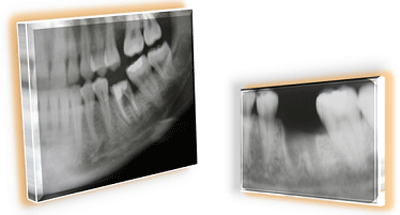 Fig 1 RX Caso numero 1