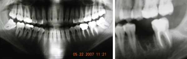 Fig 2 Rx Caso numero 2