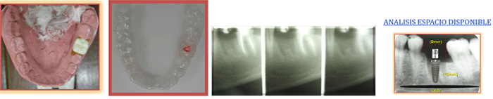 Fig. 3 Encerado, férula quirúrgica, Tomografía lineal, análisis espacio disponible.