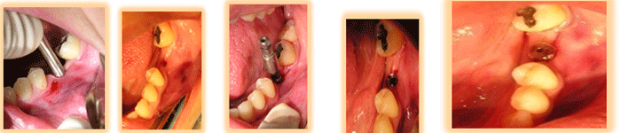 Fig. 4 Fase quirúrgica, sacabocado, colocación del implante y botón de cicatrización