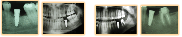 Fig. 5 Radiografias periapicales y panorámicas del Caso N: 1 y 2