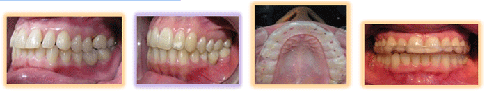 Fig.6 Instalacion corona caso 1 y 2. Ferulas Ortostaticas, caso 1 y 2 respectivamente.