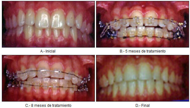 Fig. 6 - Brackets de cobinación de cerámica
