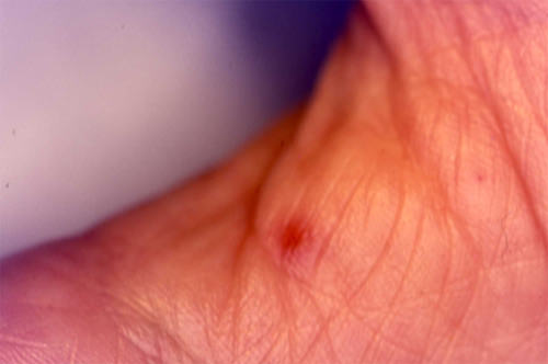 Fig. 2 Lesión macular eritematosa en piel de la mano