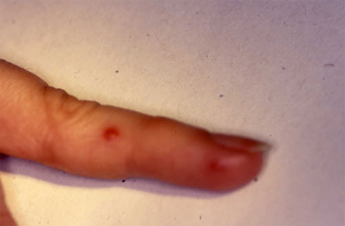 Fig. 3 Lesiones papulares eritematosas en piel del dedo