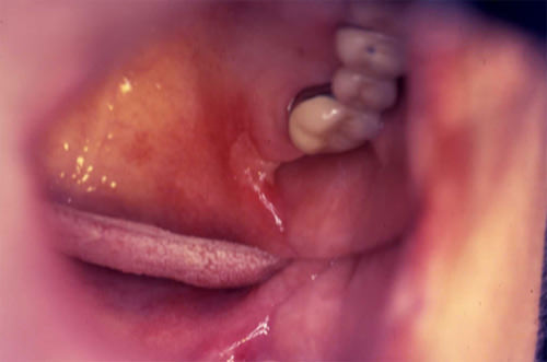Fig. 4 Lesión ulcerativa en mucosa bucal