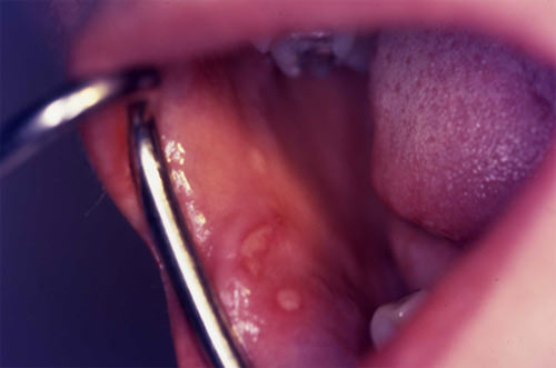 Fig. 5 Lesiones ulcerativas en mucosa del carrillo