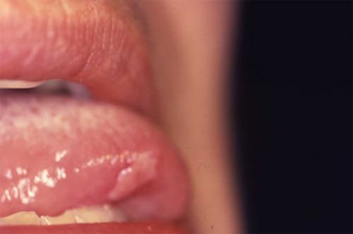 Fig. 6 Lesión ulcerativa en cara ventral de la lengua