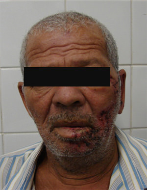 Fig. 1 Vista frontal del Herpes Zoster en región facial izquierda, afectando el trigemino
