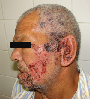 Fig. 2 Vista lateral de la lesión desde la región del pabellón auricular izquierdo hasta la región del labio inferior.