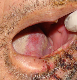 Fig. 3 Lesión en región de mucosa vestibular y lengua del lado izquierdo.