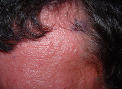 Fig. 4 Lesión del Herpes Zoster que se extiende desde la región del hueso frontal a la región de la pálpebra izquierda con oclusión palpebral.