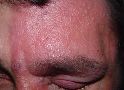 Fig. 5 Lesión que presenta hiperemia, superficie vesicular y edema en región superciliar y pálpebra izquierda