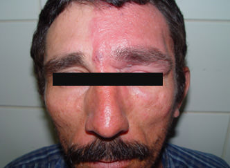 Fig. 6 Lesión ulcerativa de las vesículas en la región frontal.