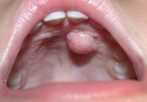Fig. 1 Lesión nodular pediculada en el paladar anterior izquierdo.