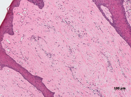 Figs. 2 y 3 Tejido fibroso fibrovascular y la presencia de fibroblastos grandes y multinucleadas con formato estrellado.