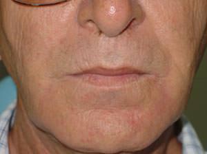Figura 16 Vista frontal evidenciando aspecto natural del rostro al final de la rehabilitación.