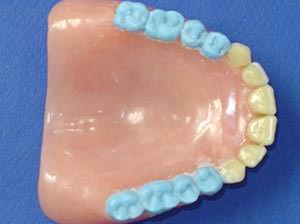 Figura 6 Vista oclusal - detalle del encerado de la prótesis total donde se busca conciliar los ajustes por desgaste con incrementos de cera para equilibrar los contactos.