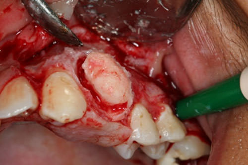 Fig 6 Osteotomía