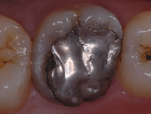 Fig. 1 Aspecto inicial de la pieza dentaria 16 con una restauración compleja de amalgama defectuosa.