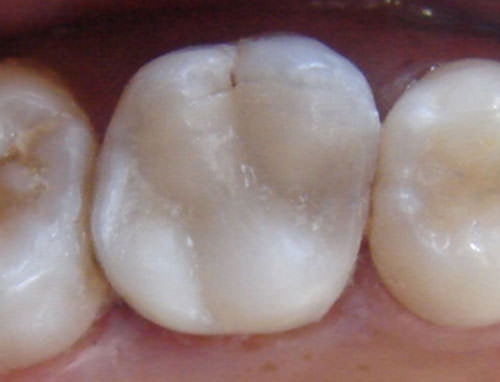 Fig. 11 Aspecto final de restauración después de la cementación.