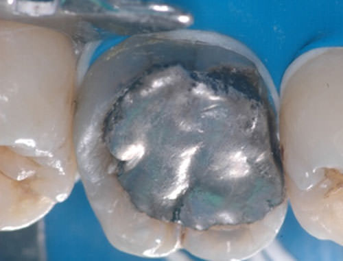 Fig. 2 Presencia de gaps en la interfase restauración/pieza dentaria.