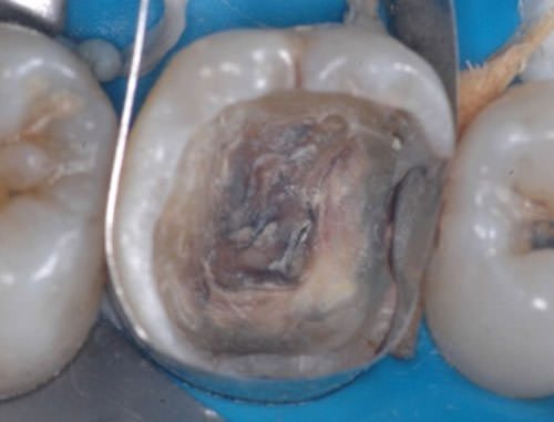 Fig. 3 Estructura dentaria remanente después de la remoción del material restaurador y relleno de las zonas retentivas con cemento de ionómero de vidrio.