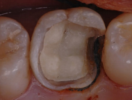 Fig. 4 Retracción gingival de la región próximo-mesial del elemento dentario 16 empleando hilo retractor para la obtención de una impresión con silicona de condensación.