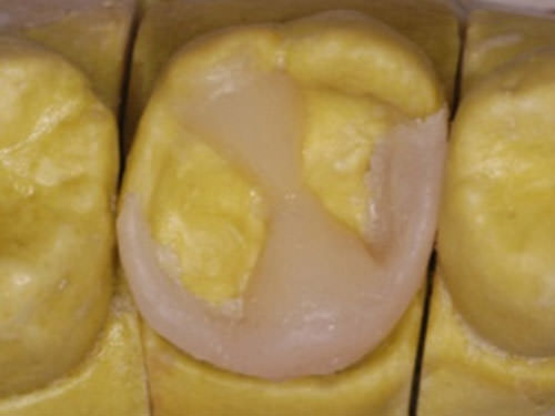 Fig. 7 Reconstrucción de las cúspides disto-vestibular y mesio-lingual con incrementos de resina de dentina (A3).