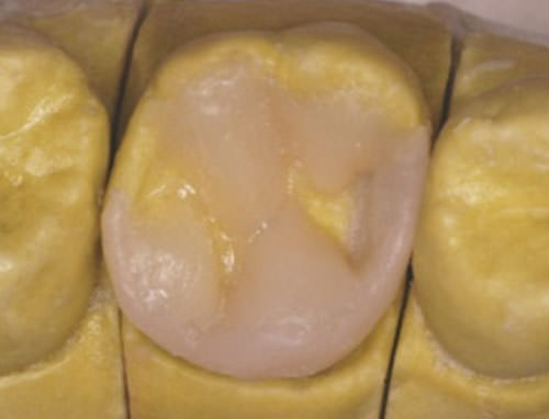 Fig. 8 Reconstrucción de las cúspides mesio-vestibular y disto-lingual con incrementos de resina de dentina (A3).