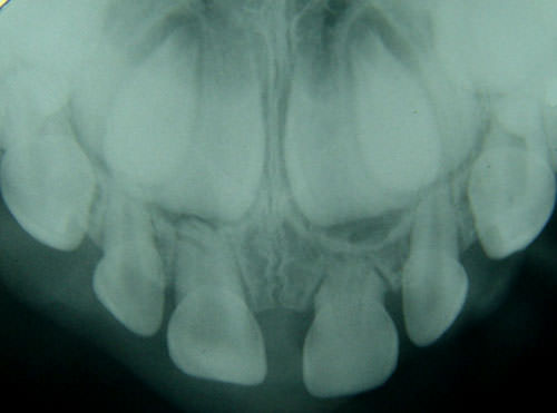 Figura 4 Radiografía de control a los 3 años mostrando reabsorción radicular más avanzada del 61 con relación a su homólogo, obliteración de la cámara pulpar coronaria del mismo, y ausencia de infección. Sucesor permanente con normal desarrollo coronario.