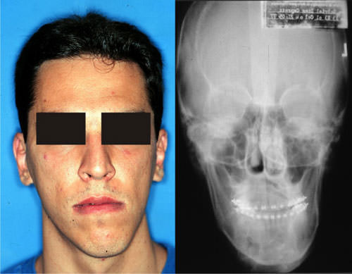 Fig. 1 Asimetría facial causada por hiperplasia y Tele-Radiografía Postero-Anterior (P.A.).
