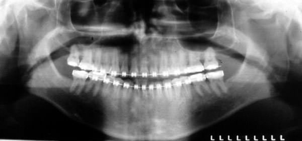 Fig. 2 Radiografía panorámica anterior a la cirugía.