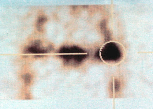 Fig. 3 Gammagrafía ósea de la Articulación.