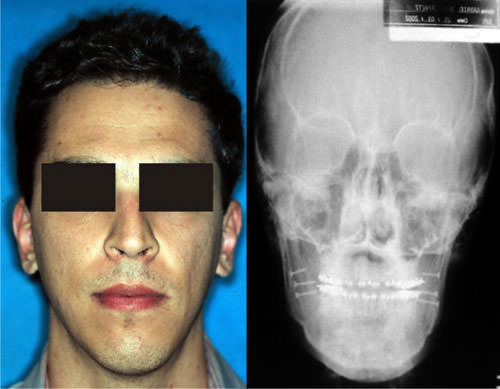 Fig. 6 Período postoperatorio de 6 años.