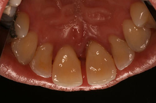 Fig. 2 Vista palatina zona ant-sup. Nótese la gran inflamación gingival en 21.