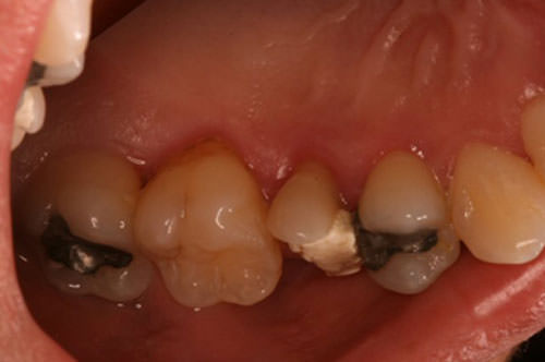 Fig. 3 Vista palatina de la inflamación gingival en los dientes 15 y 16.